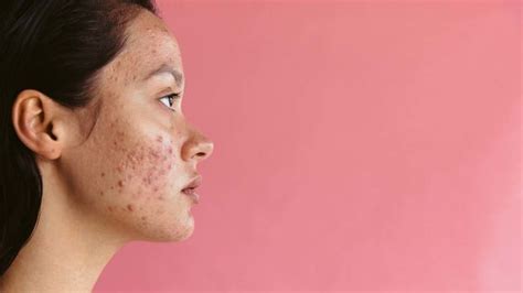 Understanding types of acne and acne severity - Sharecare