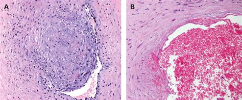 Fetal Thrombotic Vasculopathy Libre Pathology