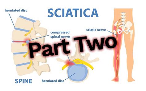 sciatic nerve part  gwinnett chiropractic