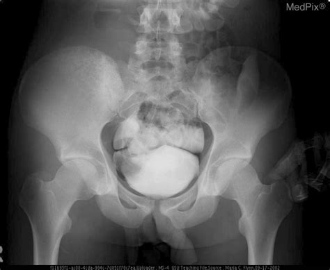 Ewing Sarcoma X Ray