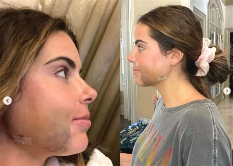 Photos Brielle Biermann Gets Jaw Surgery As Mom Kim Describes Day Of