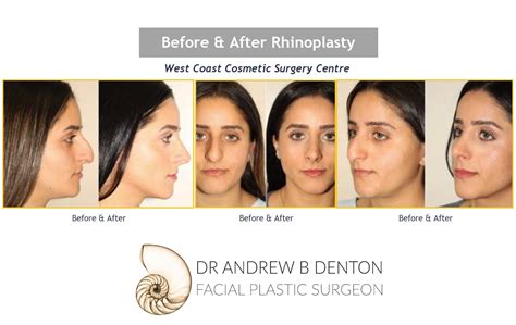 denton-rhinoplasty-recovery-before-after-female - Dr. Denton