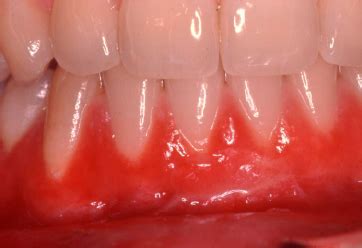 Edematous Swelling Was Found In The Labial Gingiva And Alveolar Mucosa