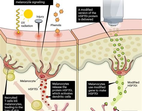 Unraveling the Promise of Genetic Therapies in Treating Vitiligo ...