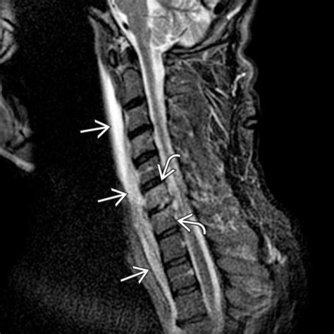 Pyogenic Osteomyelitis Clinical Tree