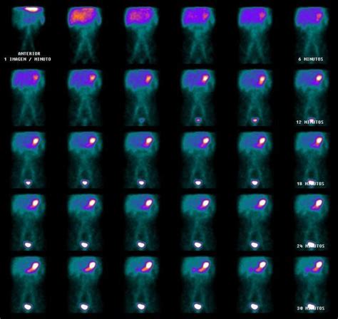 Gammagrafia Gastrica Cuernavaca Gammagrafia E Inmunoanalisis Cuernavaca