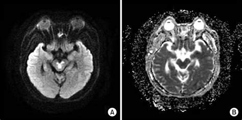 Brain Diffusion Weighted Imaging And Apparent Diffusion Coefficient Map