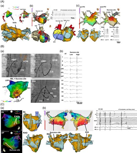 A The Electroanatomical Maps And Ct Images Of The Atrium During At