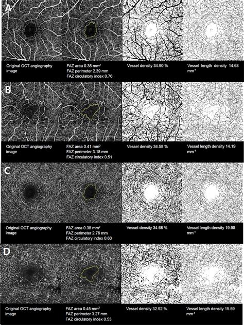 Representative En Face Optical Coherence Tomography Oct Angiography