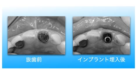 抜歯即時埋入 治療の流れ 枚方【山羽歯科医院とうかえでの道デンタルクリニック】インプラントweb