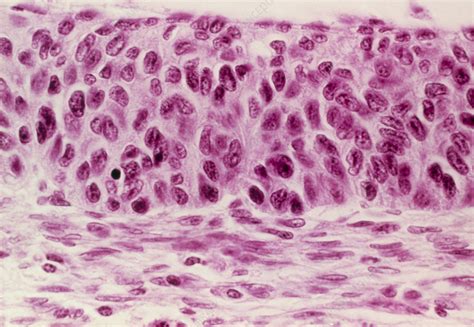 Cervical Dysplasia Histology