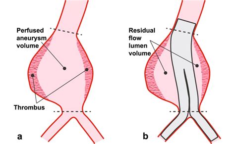 Schematic Of The Volumes Associated With Preparation For Sac