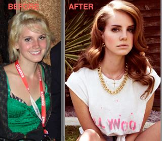 Lana Del Rey Plastic Surgery Nose Jobs, Lips Before and After Photos