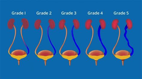 What Is Vesicoureteral Reflux Vur Youtube