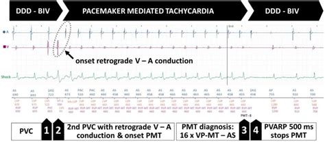 Example Of Pacemaker Mediated Tachycardia In The Context Of Premature Download Scientific