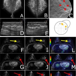 Preoperative imaging Mammography Left: Digital breast tomosynthesis... | Download Scientific Diagram