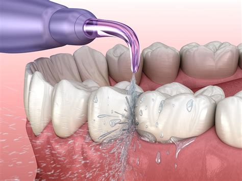 Water Flosser vs AirFlosser - Which is Better: Tempe Dentist AZ 85283