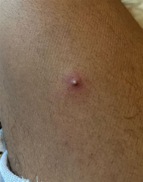 Is This A Pimple Been Here On My Thigh For About 3 Days Rdermatologyquestions