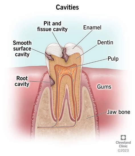 Cavities (Tooth Decay): Symptoms, Causes & Treatment