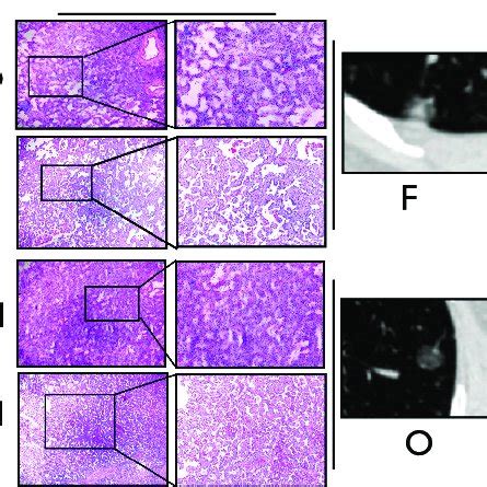 Comparison Of Frozen Section And Final Pathology In Lesions CT 350