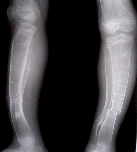 Fluoride is Poisonous: Fluorosis in the Skeleton