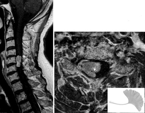 Ginkgo Leaf Sign A Highly Predictive Imaging Feature Of Spinal