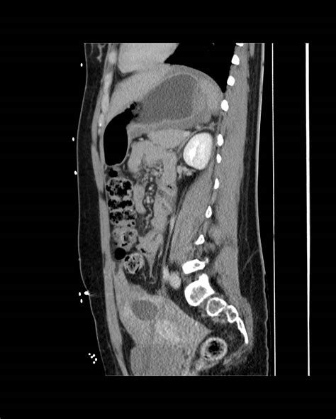 Ectopic Pregnancy Radiopaedia