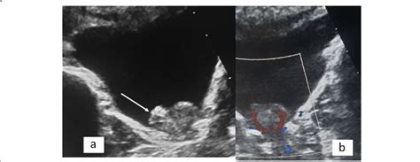 Transverse Grayscale Ultrasound A And Color Doppler B Image Through