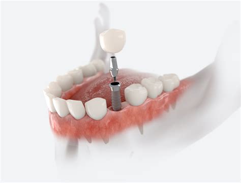 Benefits Of Dental Implants Silver Spring Tooth Implants