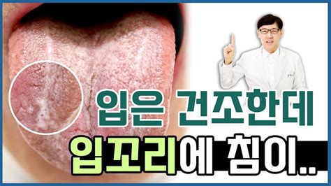 구강건조증과 구각유연증 입안은 마르는데 입꼬리에 침이 고여요 Youtube