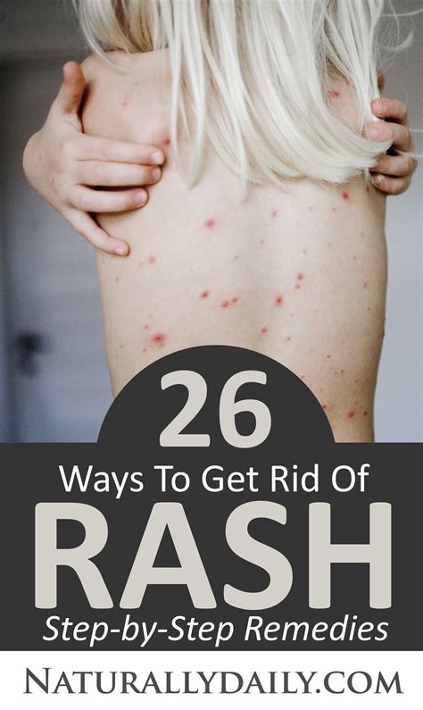 How To Get Rid Of Wine Rash at Mackenzie Corral blog