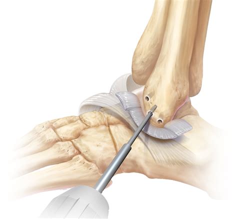 Arthrex Lateral Ankle Instability