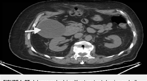 Figure 1 From A Case Of Choledocholithiasis And Obstructive Jaundice