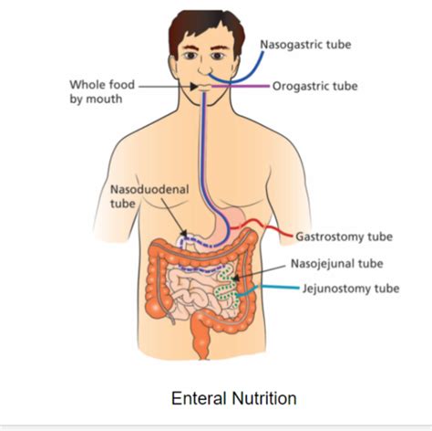 Enteral Nutrition Flashcards Quizlet