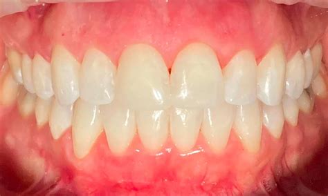 Composite Veneer To Fix A Broken Tooth Before And After Photos Austin Tx