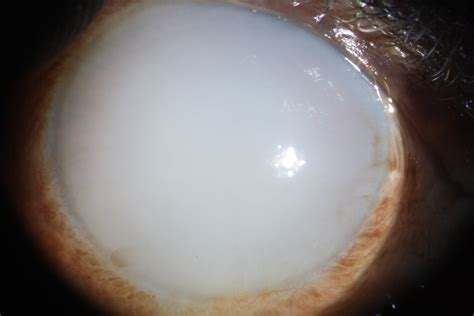 Cloudy Cornea Due To Lens Induced Phacolytic Glaucoma American