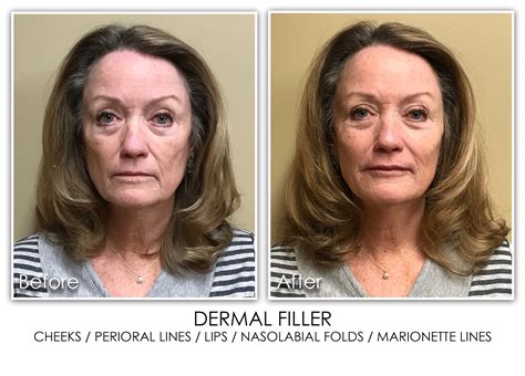 Nasolabial Fold Archives Skin Rejuvenation Clinic Skin Rejuvenation