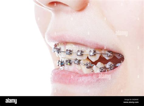 Dental Steel Braces On Teeth Close Up During Orthodontic Treatment