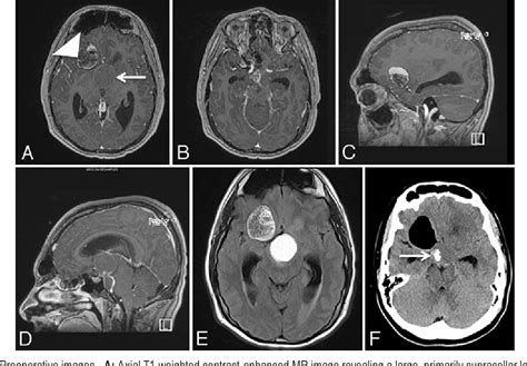 Figure 1 From Frontal Dermoid Cyst Coexisting With Suprasellar