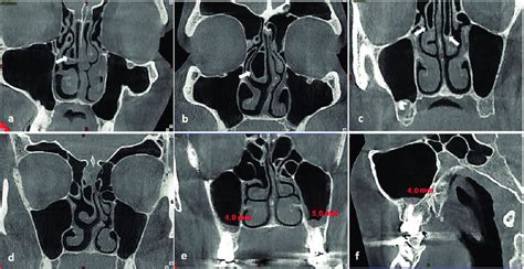 a) Bulbous type of concha bullosa, b) Extensive type of concha bullosa ...