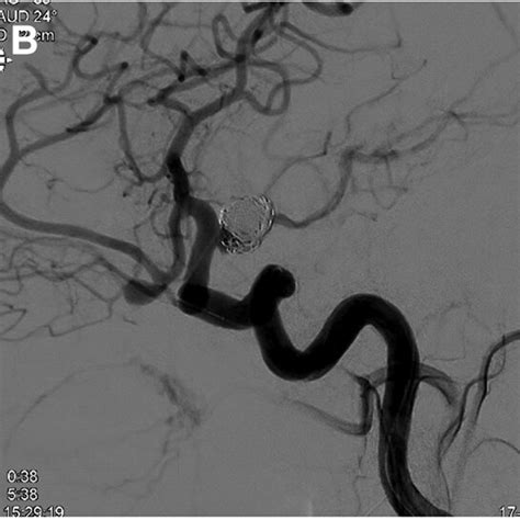 DSA At Baseline And At 6 Months Follow Up A B Sagittal Angiogram