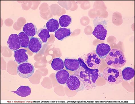 Small cell (CLL-like) variant - CELL - Atlas of Haematological Cytology