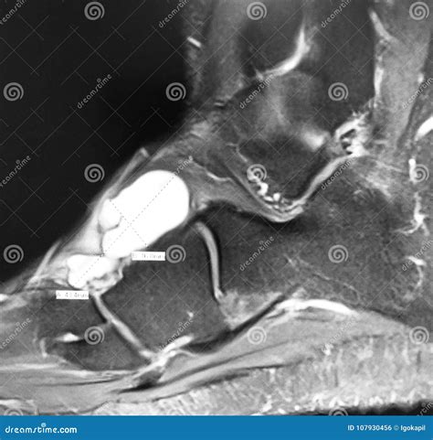 Dorsal Foot Ganglion Cyst