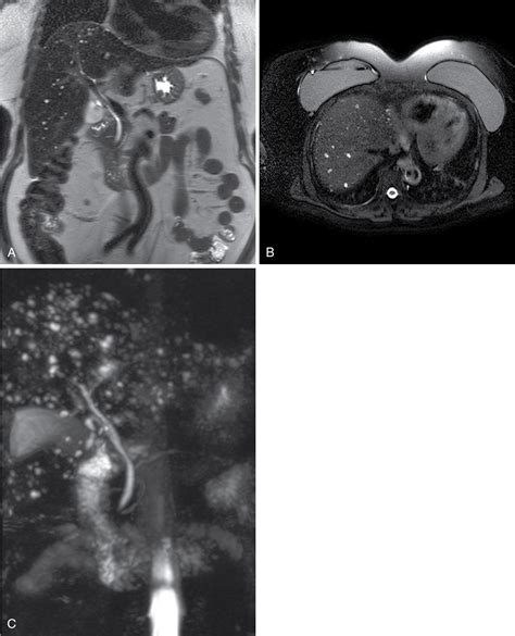 Benign Focal Liver Lesions Radiology Key