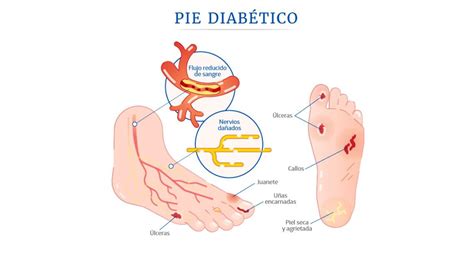 Pie diabético | uDocz