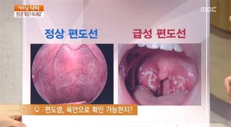 급성 편도염 예방법 소금물로 목을 예방법은`고열 몸살기 동반` 감기와 비슷 부산의 대표 정론지 국제신문