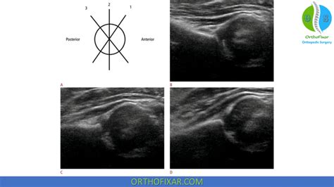 Infant Hip Ultrasound | OrthoFixar 2024