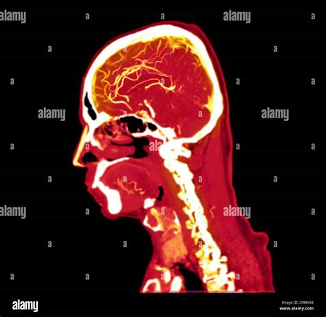 Colorful Of CT Angiography Of The Brain Or CTA Brain Sagittal View