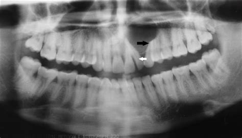 Orthopantomograph Opg Reveals Unilocular Radiolucency With An