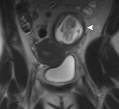 Mr Imaging Findings Of Ectopic Pregnancy A Pictorial Review